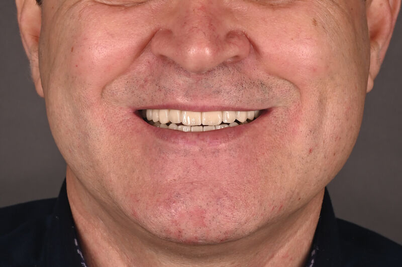 Zâmbet lateral stanga_dupa